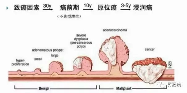 體檢查出腸息肉一定要切除！ 95%腸癌由它演變而來