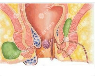 南寧哪個醫(yī)院可以做肛周膿腫？