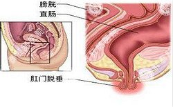 南寧治療脫肛哪家醫(yī)院好？南寧脫肛治療多少錢(qián)？